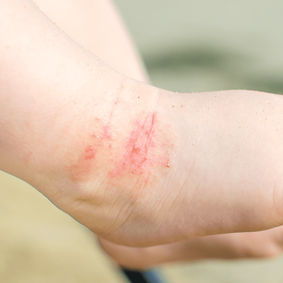 Dermatiti della Pelle: Un Problema Comune e la Soluzione Naturale