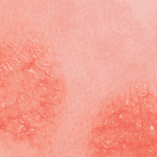 Dermatiti: Cause e Soluzioni con la Bava di Lumaca Pura e Bio